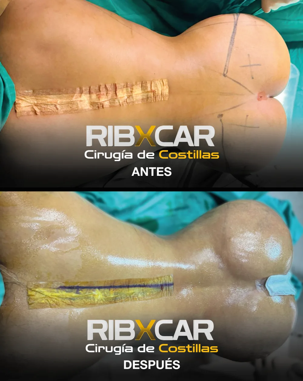 Resultado de remodelación costal RibXcar, antes y después