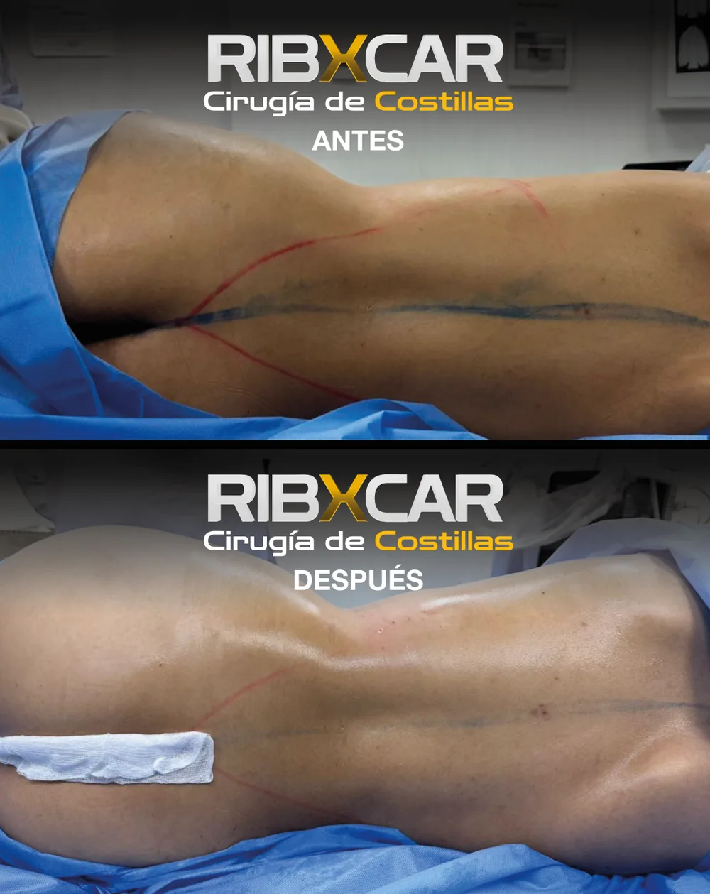 Resultado de remodelación costal RibXcar, antes y después