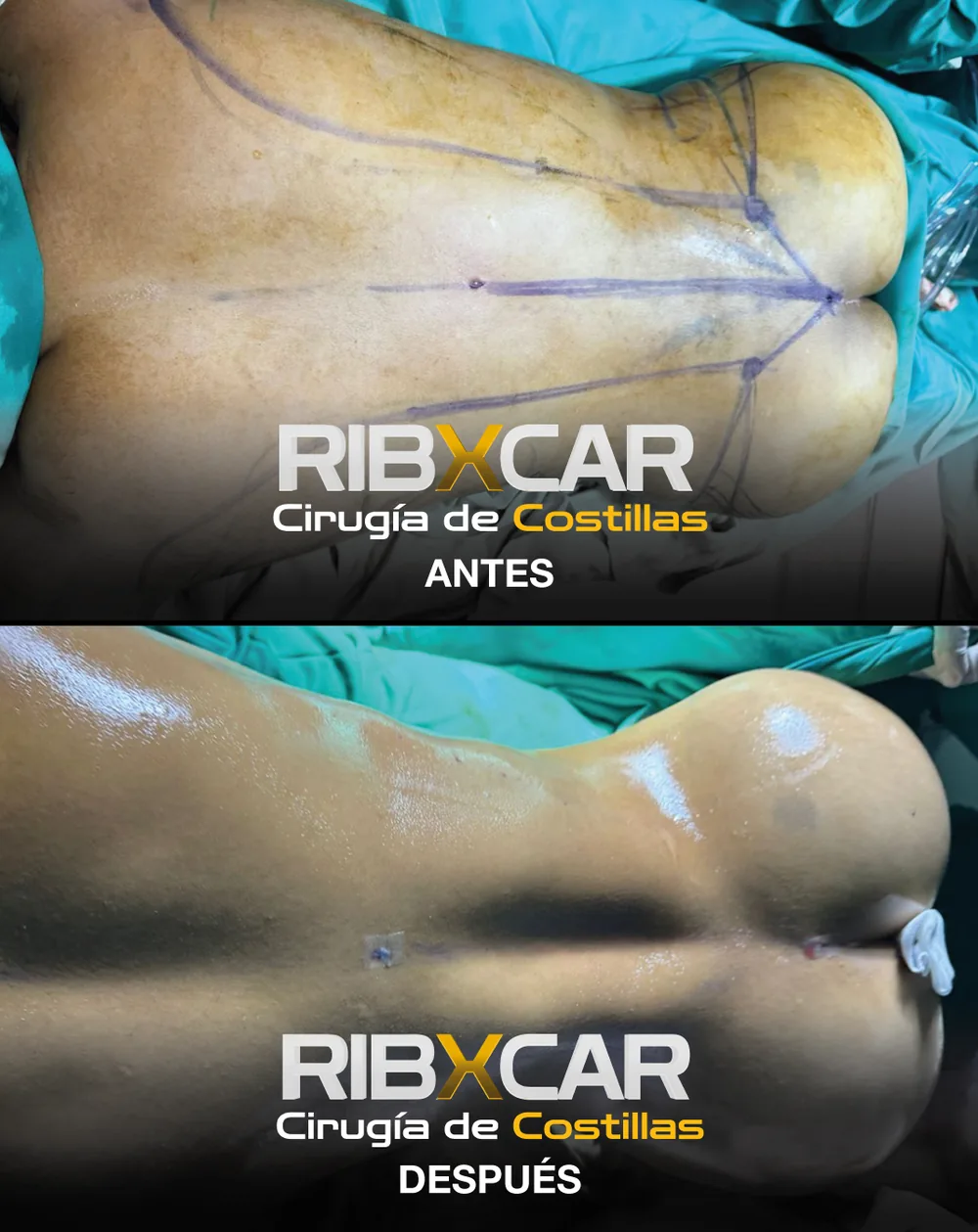 Resultado de remodelación costal RibXcar, antes y después