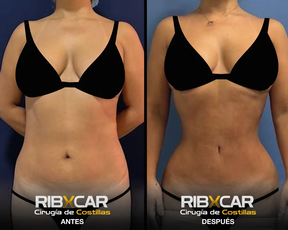 Resultado de remodelación costal RibXcar, antes y después