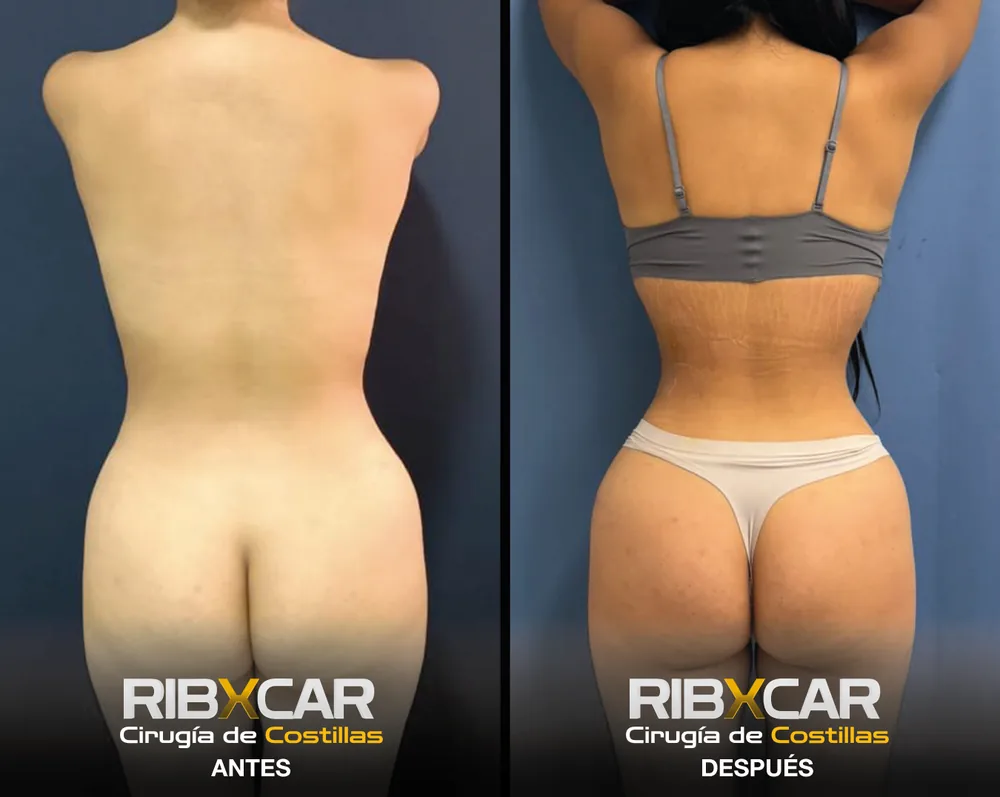 Resultado de remodelación costal RibXcar, antes y después